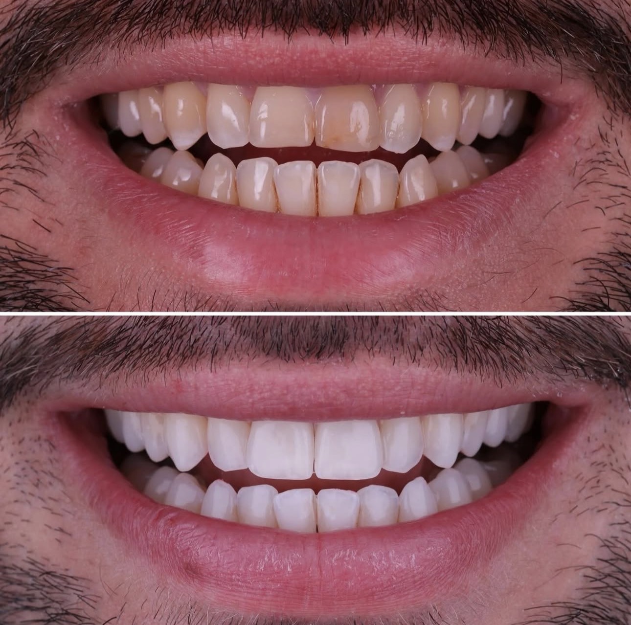 En haut, sourire initial ; en bas, sourire après éclaircissement et facettes feldspathiques, cas du Dr Jean David Boschatel