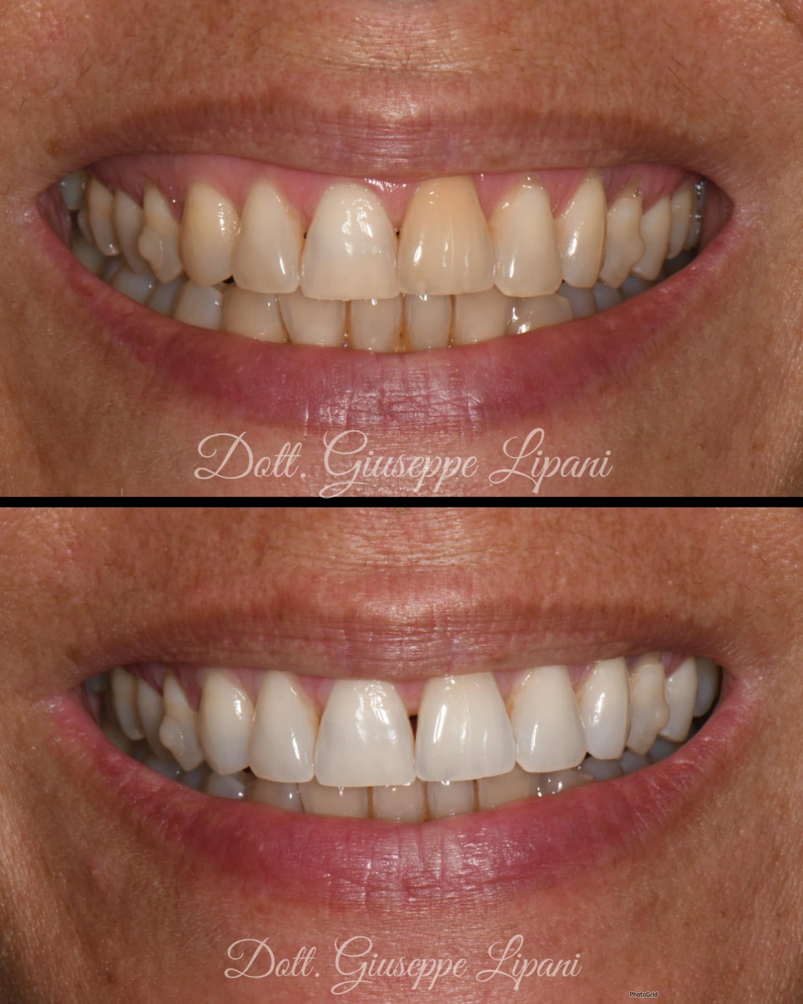 Sourire avant et après le traitement orthodontique et l’éclaircissement, Dr Giuseppe Lipani
