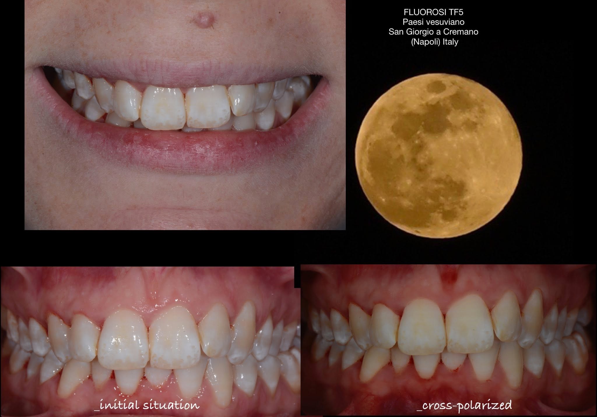 Sourire initial et documentation des lésions de fluorose
