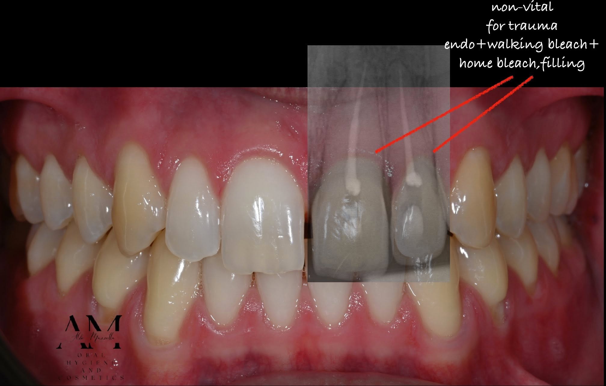 Dents 21 et 22 avec documentation radiographique