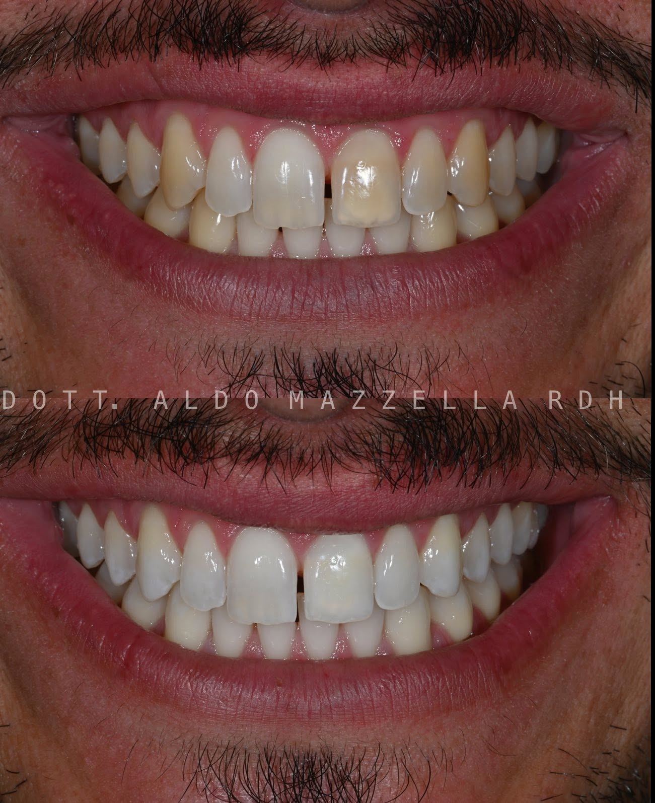 Sourire avant en haut et après en bas, cas Aldo Mazzella