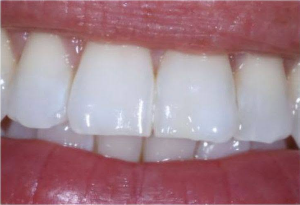 Vue des dents antérieures apres le traitement d’Aurora, cas Romina Rossoli