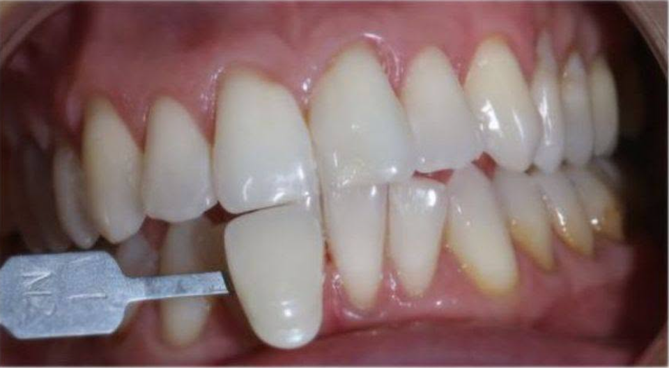 Comparaison avec le teintier avant le traitement d’Aurora, cas Romina Rossoli